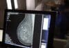 mamografia 1
